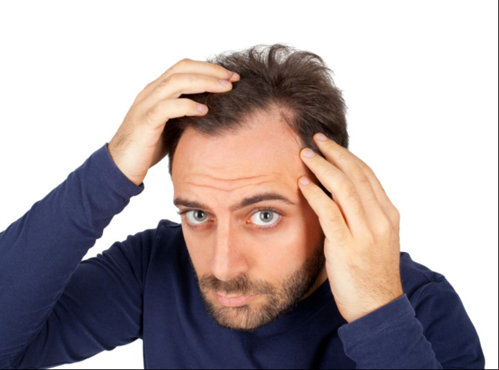 La caída de cabello, llamada alopecia, afecta al 50 % de los hombres mayores de 50 años.