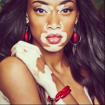 Síndrome de Down, vitiligo y sillas de ruedas: la diferencia reina en las pasarelas