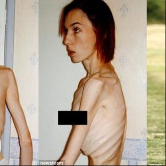 Anorexia: pesaba 30 kilos y creían que moriría; hoy terminó la universidad