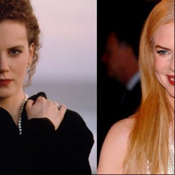 Nicole Kidman antes y después del Botox: ¿era necesario?