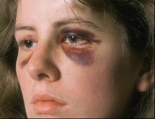 Violencia de género: resiliencia para recuperar el rol protagónico