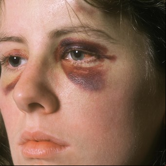 Violencia de género: resiliencia para recuperar el rol protagónico