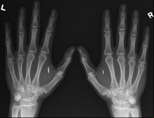 Más de 10 mil personas ya se implantaron en el cuerpo un chip informático
