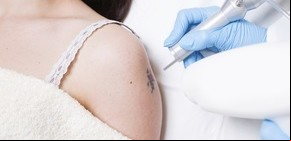 Esas poderosas razones para eliminar un tatuaje