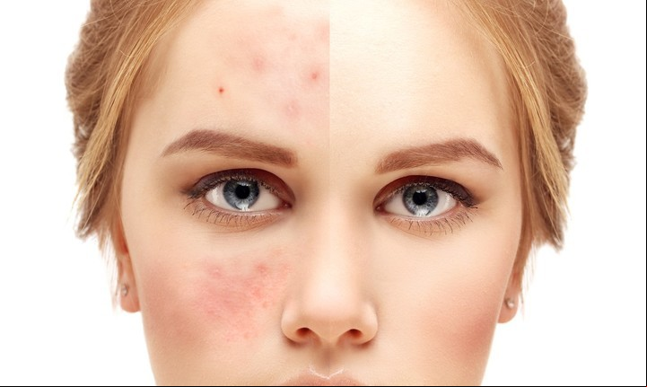 Marcas de acné, vitiligo y hasta arrugas, objetivos del preparado con hojas de laurel.