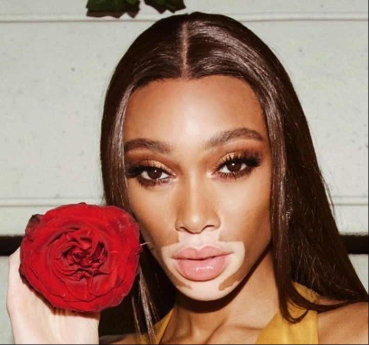 Entre el 0,5 y el 3% de la población sufre vitiligo, la enfermedad que tiene Winnie Harlow (Instagram Winnie Harlow)