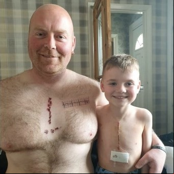 Un padre se tatuó una cicatriz igual a la que una cirugía de corazón le dejó a su hijo