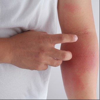 Vivir con dermatitis atópica: qué es y cómo impactó la pandemia en la piel de los pacientes
