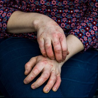 Dermatitis atópica: síntomas, factores que elevan la sospecha y la revolución en la "escalera terapéutica"
