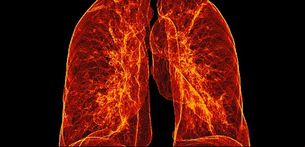 Reviven pulmones inservibles para trasplantes