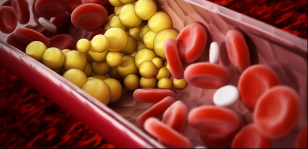 Colesterol alto: 10 síntomas muy comunes para tener en cuenta