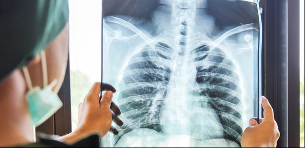 Cáncer de pulmón: un nuevo estudio asocia el diagnóstico temprano a una sustancial reducción de muertes
