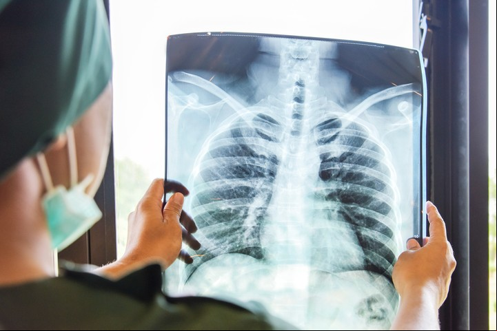 La detección del cáncer de pulmón de manera temprana es clave para un tratamiento exitoso. Foto Shutterstock.
