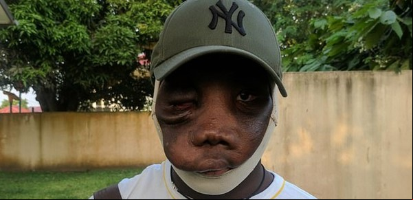 Su madre lo abandonó por su tumor en la cara, pero se sobrepuso y encontró la cura