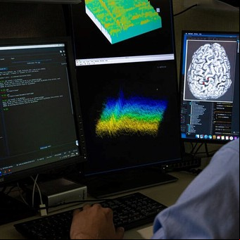 Un implante cerebral permite que paciente totalmente paralizado se comunique