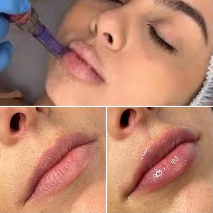 Tratamientos estéticos postpandemia. Hidrogloss o Hidrolabios.