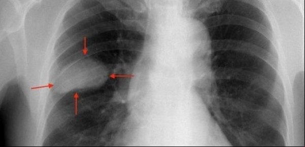 Cáncer de pulmón: llegó al país un tratamiento que logra una sobrevida inédita
