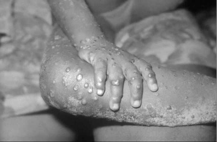 Imagen de una nena con lesiones provocadas por viruela del mono en Bondua, Liberia, en 1971. Foto CDC.
