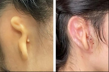 Trasplantan una oreja creada con células humanas en impresión 3D
