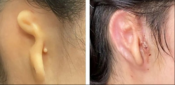 Trasplantan una oreja creada con células humanas en impresión 3D
