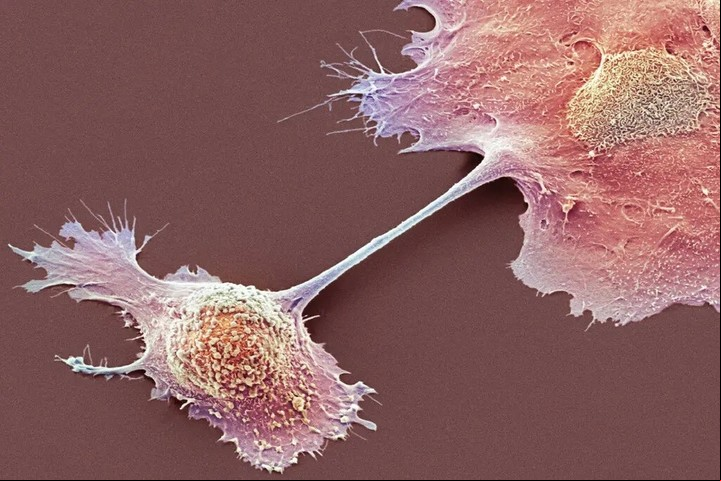 Células de cáncer de páncreas tomadas con técnicas de microfotografía. Foto: Archivo Clarín.
