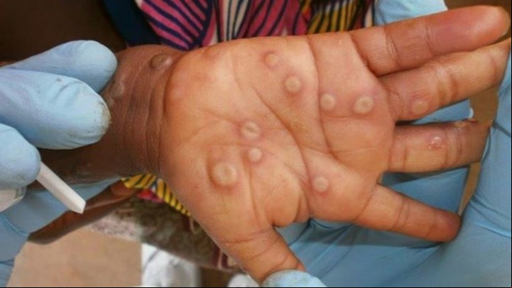 Lesiones típicas en la piel producidas por la viruela del mono. Foto: UK Health / Monkeypox Rash Photos