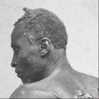La historia de "Peter azotado", el esclavo que escapó y conmovió al mundo con su enorme cicatriz queloide
