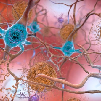 Esperanza contra el Alzheimer: una nueva droga logró frenar el deterioro cognitivo