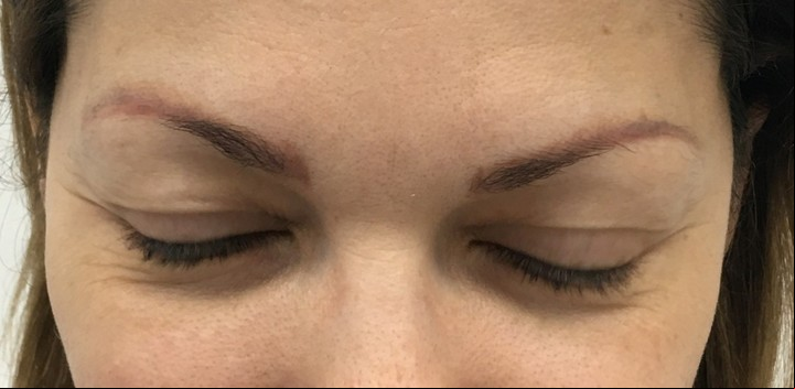 Paciente con alopecía en las cejas. Se había realizado una dermopigmentación