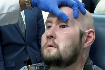 Hito médico: por primera vez realizaron un trasplante de ojo completo
