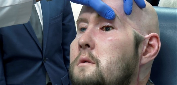 Hito médico: por primera vez realizaron un trasplante de ojo completo