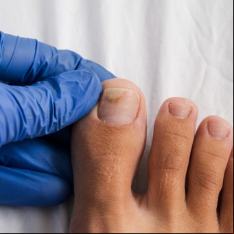 Hongos en pies y manos: por qué en las uñas son difíciles de tratar y los errores más comunes