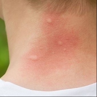 Cómo saber si la picadura es del mosquito del dengue o del que transmite encefalitis
