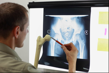 Cuántos años puede vivir una persona con síndrome de huesos de cristal u osteogénesis imperfecta