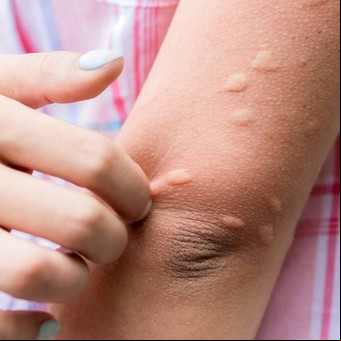 ¿Cuánto tiempo puede durar una alergia en la piel?
