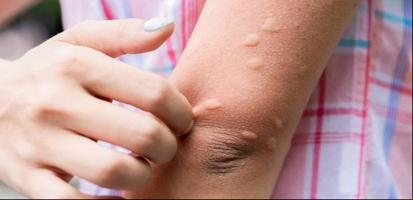¿Cuánto tiempo puede durar una alergia en la piel?