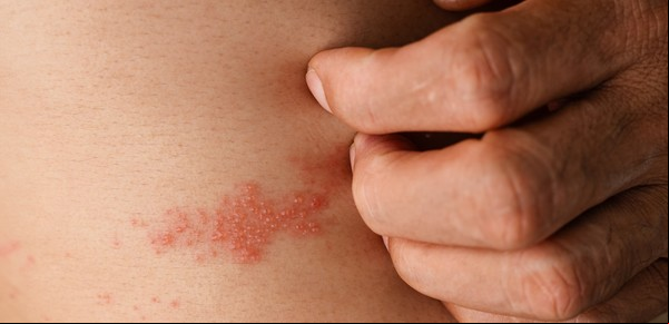 Herpes Zóster: cómo se reactiva el virus de la varicela y qué deben saber los mayores de 50 años