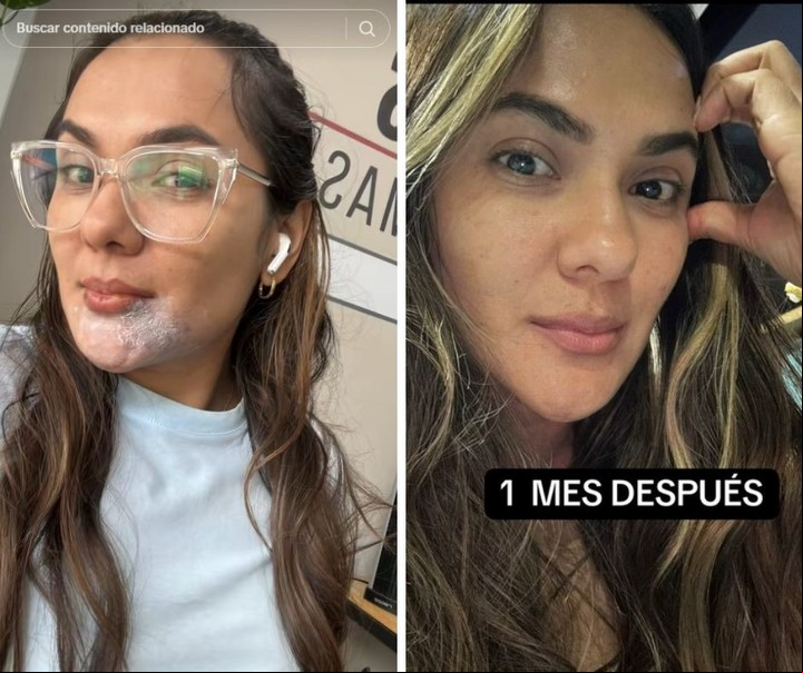 La mujer recibió un tratamiento con cremas en la zona afectada hasta recuperarse por completo. Foto: captura de video/TikTok @natalyrubiio.
