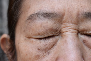 Daño solar: qué hacer si aparecen melasmas, lentigos o manchas en el rostro