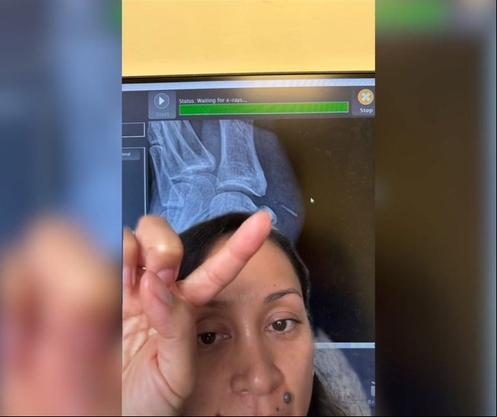 En esta radiografía de pie de la mujer, se puede observar la espina clavada en la zona. Foto: captura/@christinalkblack.