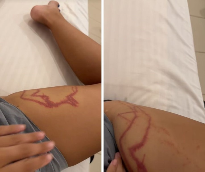 La roncha causada por la picadura del animal marino. Foto: captura de video/TikTok @julieanddaniel_.