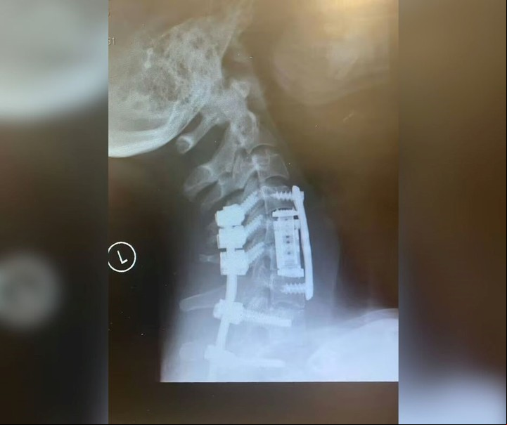 Una radiografía del cuello de la joven, luego de la operación. Foto: Becca.