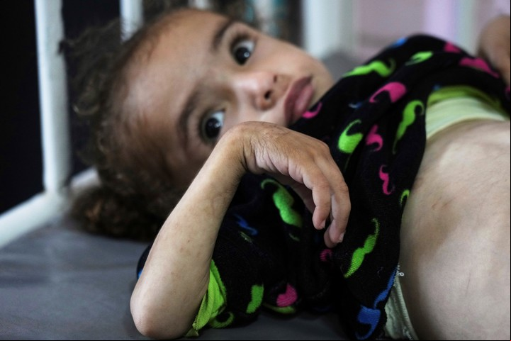 Mayar Al-Arja, de 2 años, sufre malnutrición en el hospital Nasser. Foto: AP