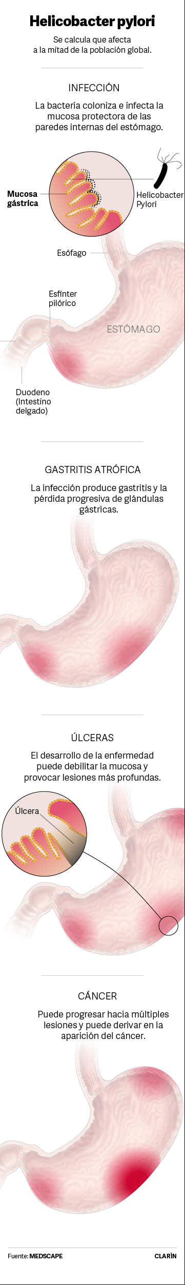 Helicobacter pylori